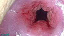 Japan Mom Cervix open wide Dilatation and fucking Uterus with Insertion of huge Objects