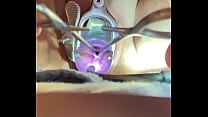 Teeth of tenaculum bite into cervix
