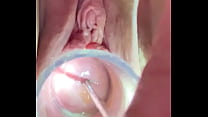 Cervical sounding deeply