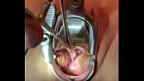 Straightening cervical canal with sound tenaculum