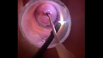 Electrosound cervix and m