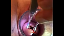 Gyno instrument painfully opens cervix