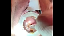 Painful stretching cervix w sound