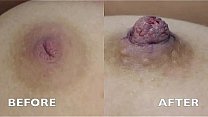 Inverted Nipple Correction - Audio Testimonial   Photos - Aurora Clinics