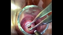 Rosebud into uterus via endocervical speculum